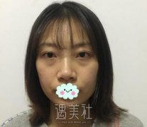 玻尿酸垫下巴前后对比果图片：下巴拯救一个人的颜值~ width=