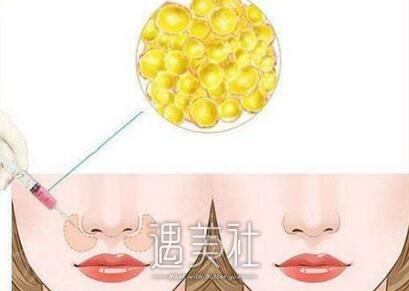 脂肪填充术