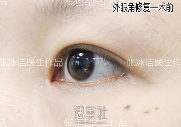 张冰洁医生外眼角修复案例：大小手术都得去正规机构啊～