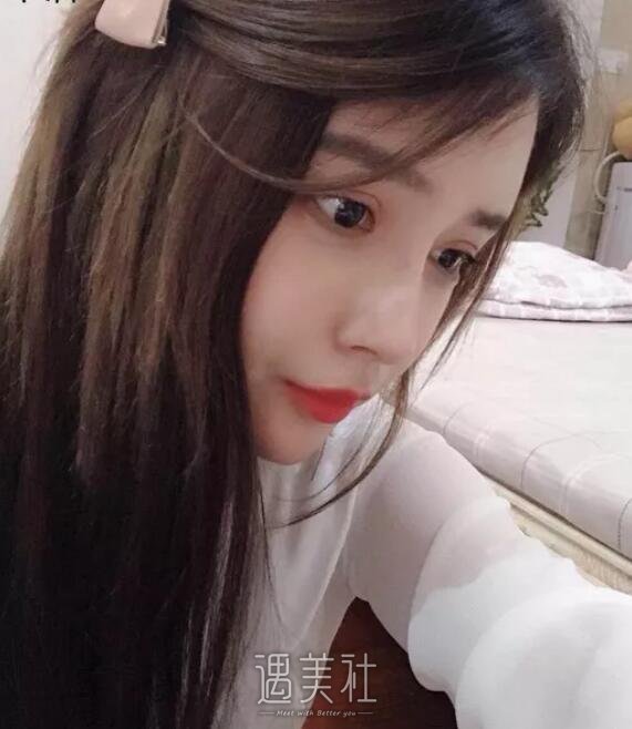 石家庄美联臣做了注射胶原蛋白隆鼻，现在的鼻型很八错～