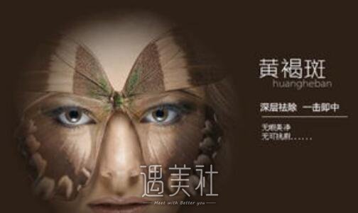 威海,激光黄褐斑