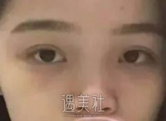 短鼻子整形后的图片分享——短鼻子整形术后恢复全记录～ width=
