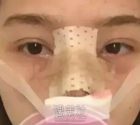 短鼻子整形