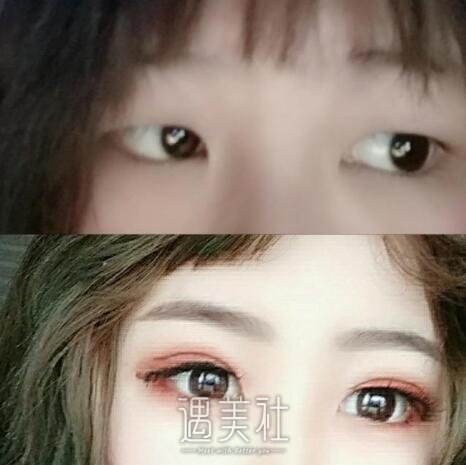 亚韩割双眼皮多少钱，为什么各地的价格都不固定喃?