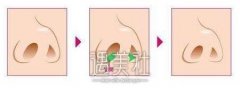 酒泉做缩鼻翼手术大概要多少钱?鼻翼大了来太丑啦~ width=