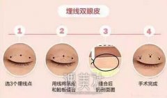 宝鸡市做定位双眼皮多少钱?做个双眼皮应该不得贵哟? width=