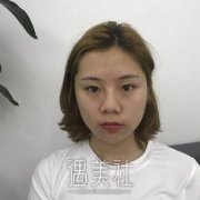 找鲍继荣医生做了隆鼻，明白了为什么那么多人青睐他! width=