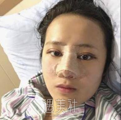 成都,西区,隆鼻