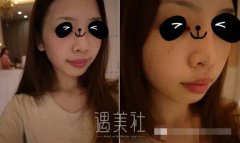 激光去黄褐斑有吗?激光去黄褐斑案例硬核来证实! width=