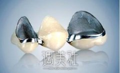 镍铬烤瓷牙的危害大不大?镍铬烤瓷牙真的会致癌吗? width=