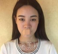 吉大一院整形外科邵英双眼皮做得好吗？真实案例瞧瞧~ width=