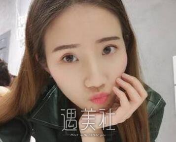 徐永安,面部填充