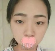 钱云良做双眼皮怎么样|钱云良双眼皮案例硬核来袭~ width=