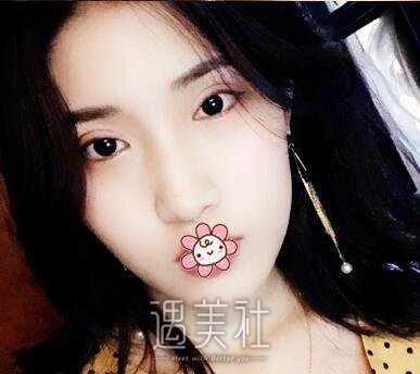 曹卫刚,割双眼皮