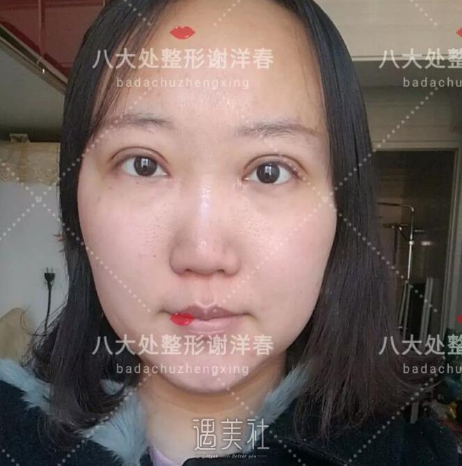 谢洋春双眼皮案例：终于不用每天“眯着眼”了~