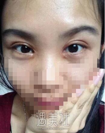 杨明勇双眼皮案例：早就有耳闻杨医生做双眼皮很牛皮~