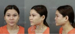 泰国小姐姐专程飞来我院做鼻面综合？ width=