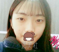 钱云良做双眼皮好不好|钱云良双眼皮案例硬核力证~ width=