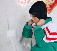 张正文答患者问（42）：耳畸形对孩子的心理影响大吗？ width=