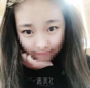 莫志波双眼皮手术案例分享，从此告别单眼皮认识~ width=
