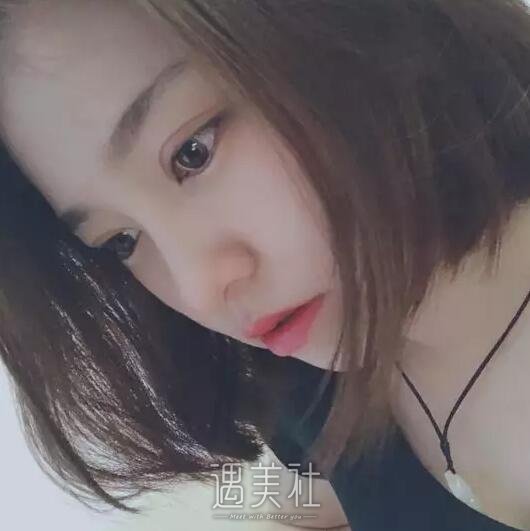 莫志波双眼皮手术案例分享，从此告别单眼皮认识~