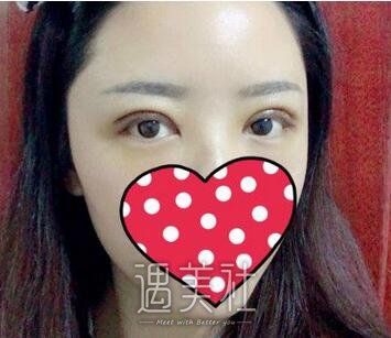 陈辉,双眼皮