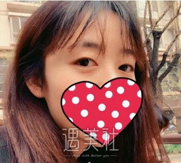 陈辉,双眼皮