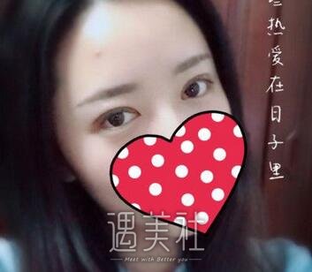 陈辉,双眼皮