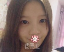 范飞隆鼻案例 width=
