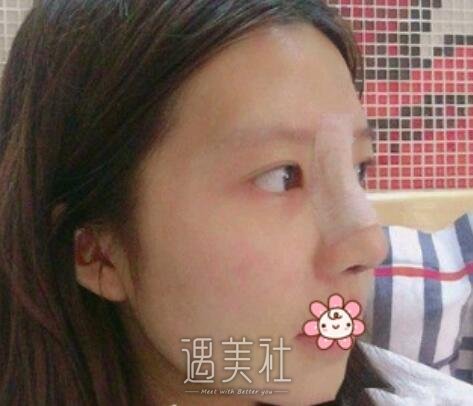 范飞，隆鼻