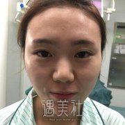 黄文隆鼻案例：每天都要美美哒~ width=
