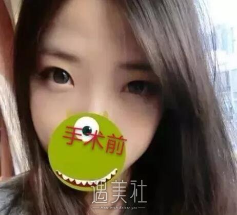 弋矶山医院整形科实力如何?双眼皮真实案例分享~