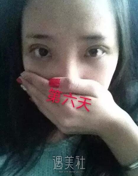 弋矶山医院整形科实力如何?双眼皮真实案例分享~