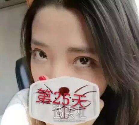 弋矶山医院整形科实力如何?双眼皮真实案例分享~