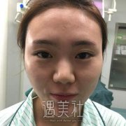 潍坊医学院隆鼻案例：三个月变女神不好看也难~ width=