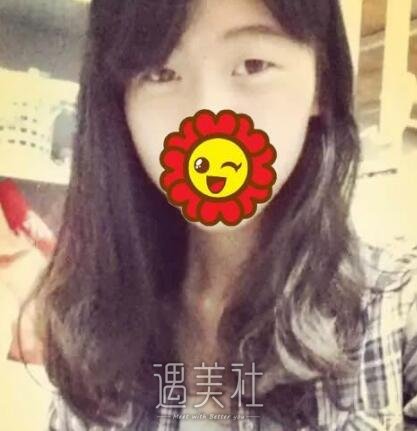 义乌张小红,双眼皮