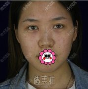 四川友谊医院李萍综合隆鼻整形案例：矫正了我的鼻骨和宽鼻~ width=