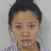 郑学东隆鼻案例图：五官瞬间变得立体有型啦! width=