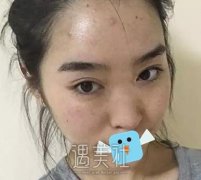鲍继荣隆鼻手术怎么样，三个月案例真实感受 width=