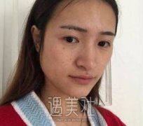 下颌角截骨手术果怎么样呢，可以真的变瓜子脸吗? width=