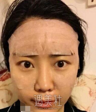 李发成,自体脂肪填充