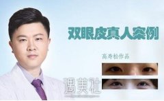 高寿松双眼皮案例：真后悔没有早一点做啊！ width=