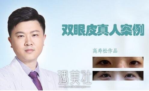 高寿松,双眼皮