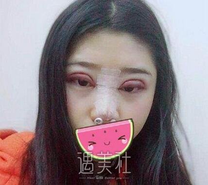 高寿松,双眼皮