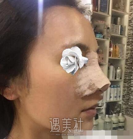 赵延勇,隆鼻