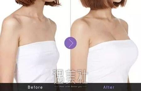 昆明韩式隆胸价格贵不贵，需要多少钱搞定?