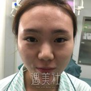 杜太超隆鼻案例图片分享：果太好啦有超出预期哦! width=