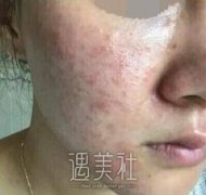 光子嫩肤祛痘真实案例分享：终于摆脱痘痘肌~ width=