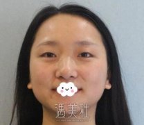 王英勇双眼皮案例：果是我想要的哦！ width=