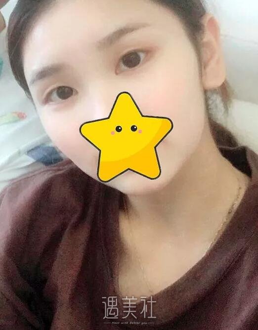 叶信海双眼皮案例：我还是大眼睛好看呐!